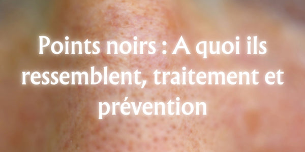 Points noirs : A quoi ils ressemblent, traitement et prévention