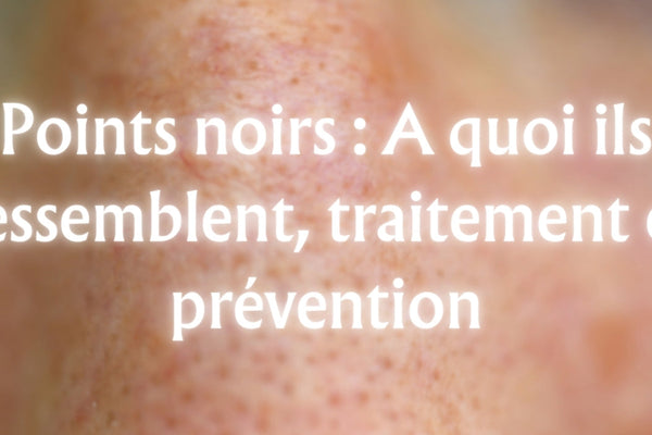 Points noirs : A quoi ils ressemblent, traitement et prévention