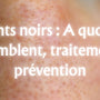Points noirs : A quoi ils ressemblent, traitement et prévention