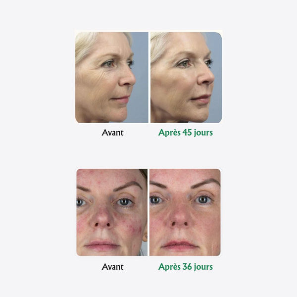 Nalovea Opalys™ Masque LED anti-âge